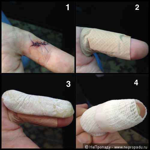 Рана первого пальца