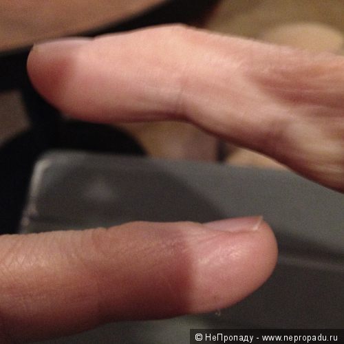 Травма пальцев